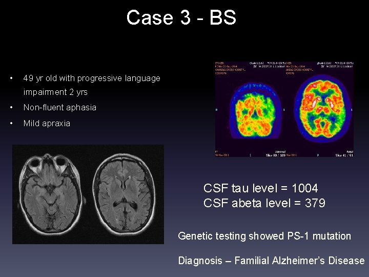 Case 3 - BS • 49 yr old with progressive language impairment 2 yrs