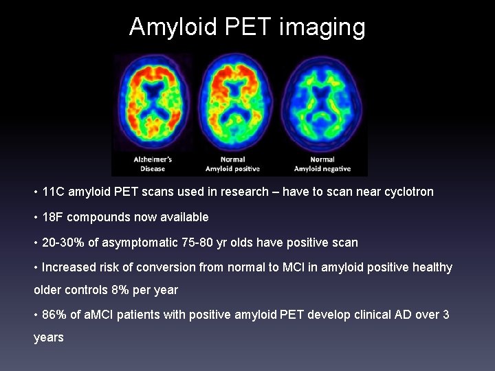 Amyloid PET imaging • 11 C amyloid PET scans used in research – have