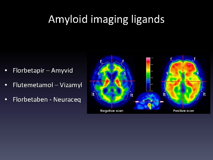 Amyloid imaging ligands • Florbetapir – Amyvid • Flutemetamol – Vizamyl • Florbetaben -