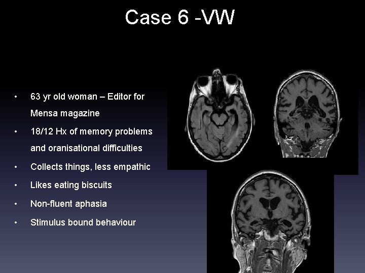 Case 6 -VW • 63 yr old woman – Editor for Mensa magazine •