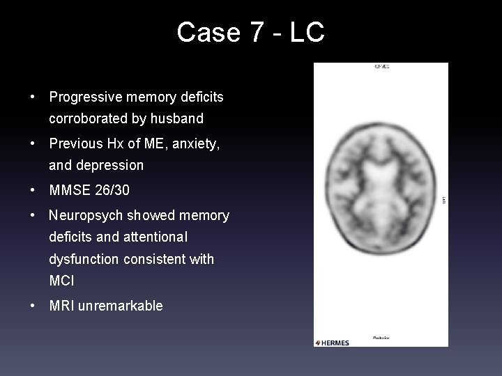 Case 7 - LC • Progressive memory deficits corroborated by husband • Previous Hx