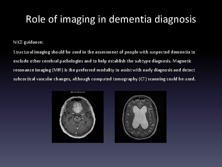 Role of imaging in dementia diagnosis NICE guidance: Structural imaging should be used in