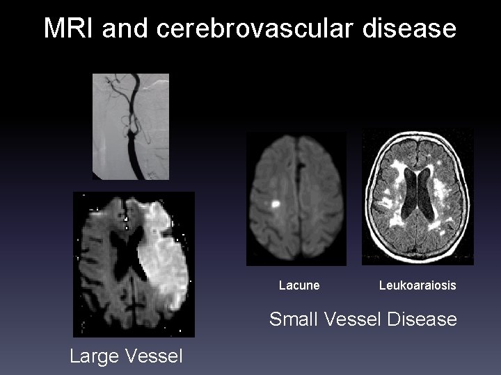 MRI and cerebrovascular disease Lacune Leukoaraiosis Small Vessel Disease Large Vessel 