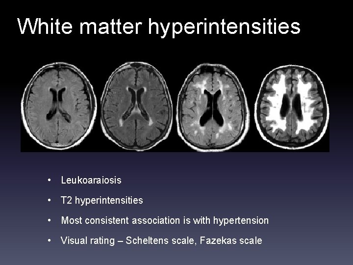 White matter hyperintensities • Leukoaraiosis • T 2 hyperintensities • Most consistent association is