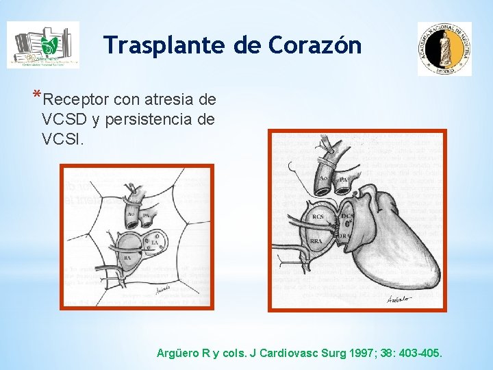 Trasplante de Corazón *Receptor con atresia de VCSD y persistencia de VCSI. Argüero R