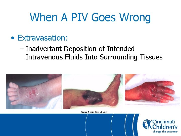 When A PIV Goes Wrong • Extravasation: – Inadvertant Deposition of Intended Intravenous Fluids