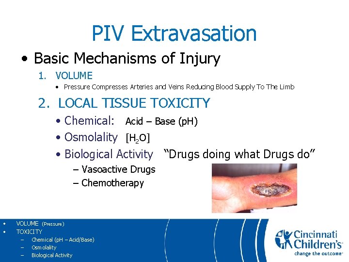 PIV Extravasation • Basic Mechanisms of Injury 1. VOLUME • Pressure Compresses Arteries and