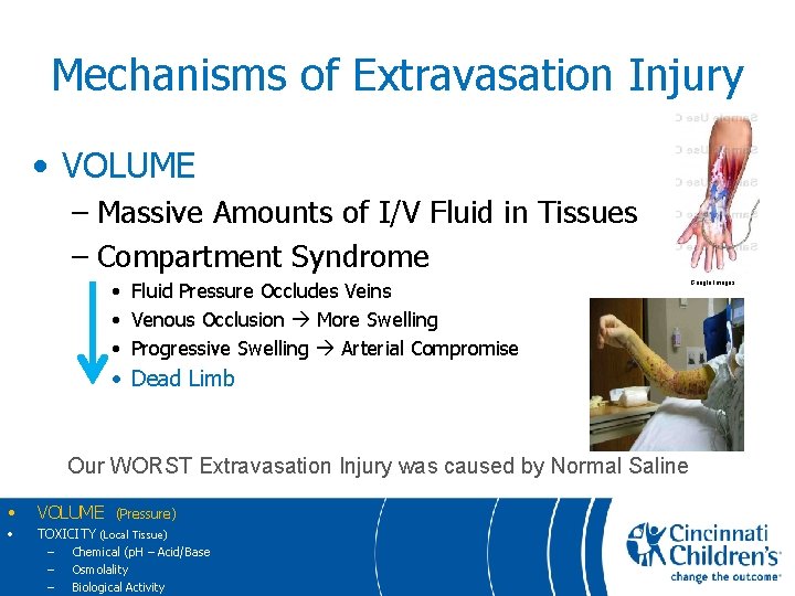 Mechanisms of Extravasation Injury • VOLUME – Massive Amounts of I/V Fluid in Tissues
