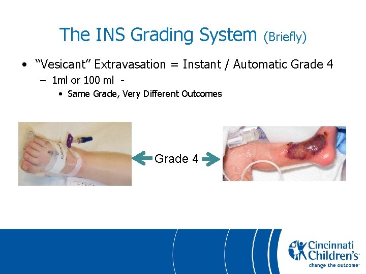 The INS Grading System (Briefly) • “Vesicant” Extravasation = Instant / Automatic Grade 4