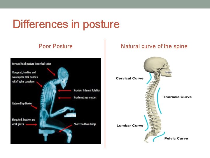 Differences in posture Poor Posture Natural curve of the spine 