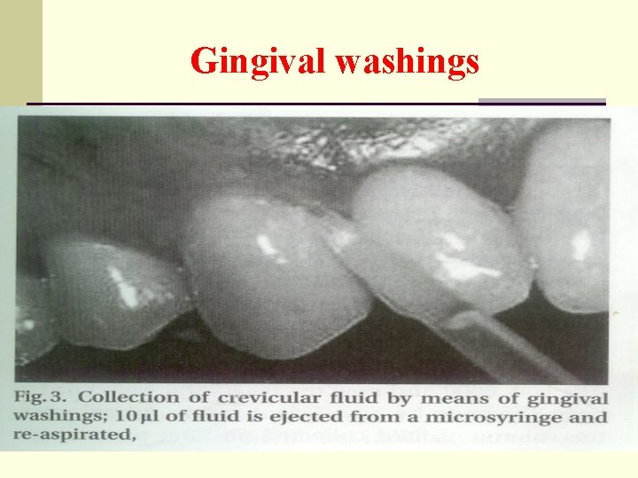 Gingival washings 