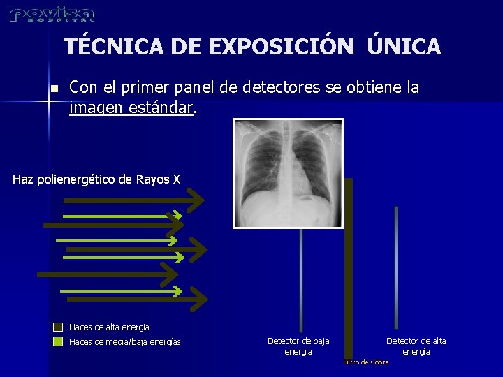 TÉCNICA DE EXPOSICIÓN ÚNICA n Con el primer panel de detectores se obtiene la