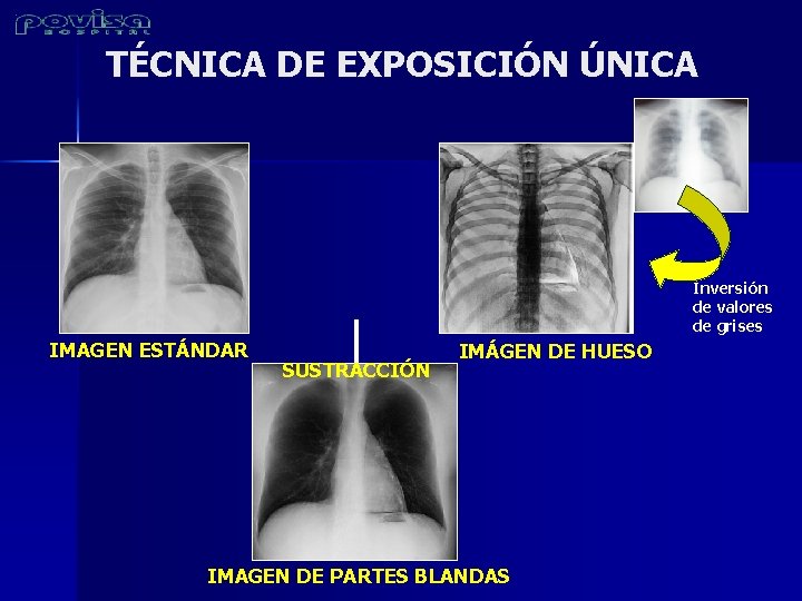 TÉCNICA DE EXPOSICIÓN ÚNICA Inversión de valores de grises IMAGEN ESTÁNDAR SUSTRACCIÓN IMÁGEN DE