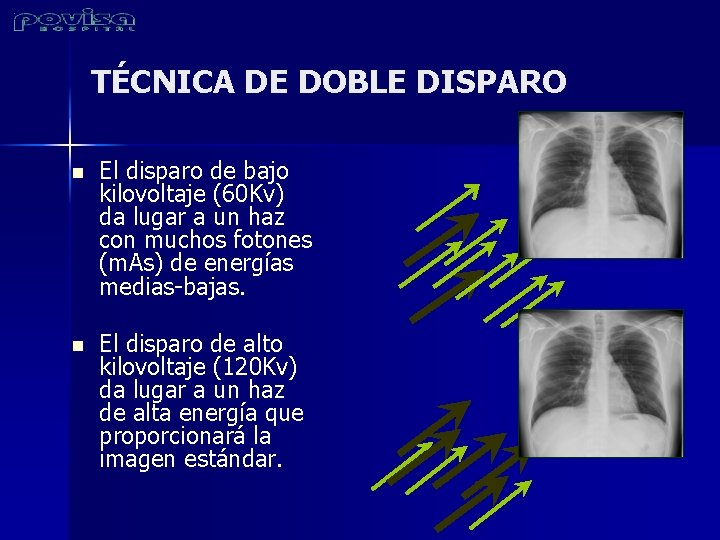 TÉCNICA DE DOBLE DISPARO n El disparo de bajo kilovoltaje (60 Kv) da lugar