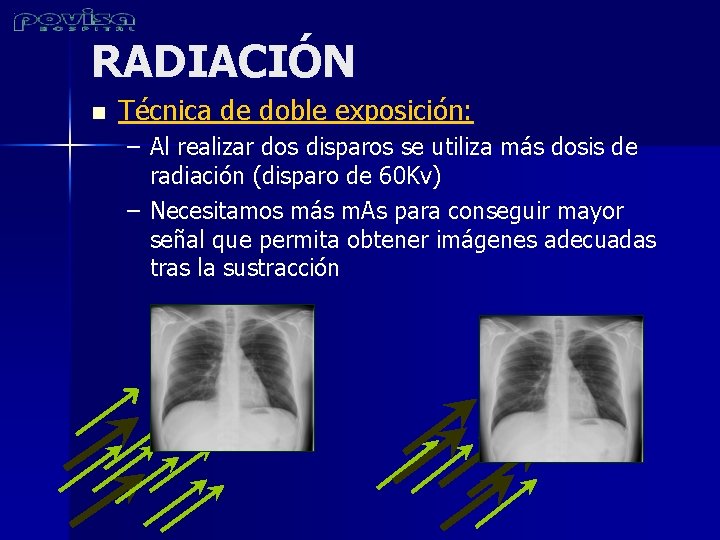 RADIACIÓN n Técnica de doble exposición: – Al realizar dos disparos se utiliza más