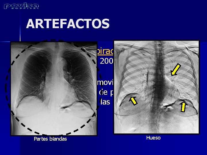 ARTEFACTOS n n Artefacto por respiración: Debido a que existe un retraso de 200