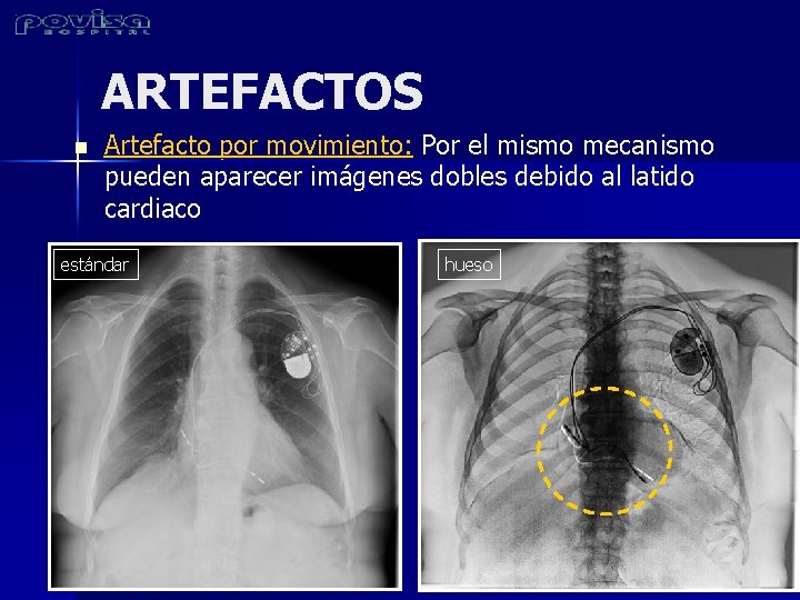 ARTEFACTOS n Artefacto por movimiento: Por el mismo mecanismo pueden aparecer imágenes dobles debido