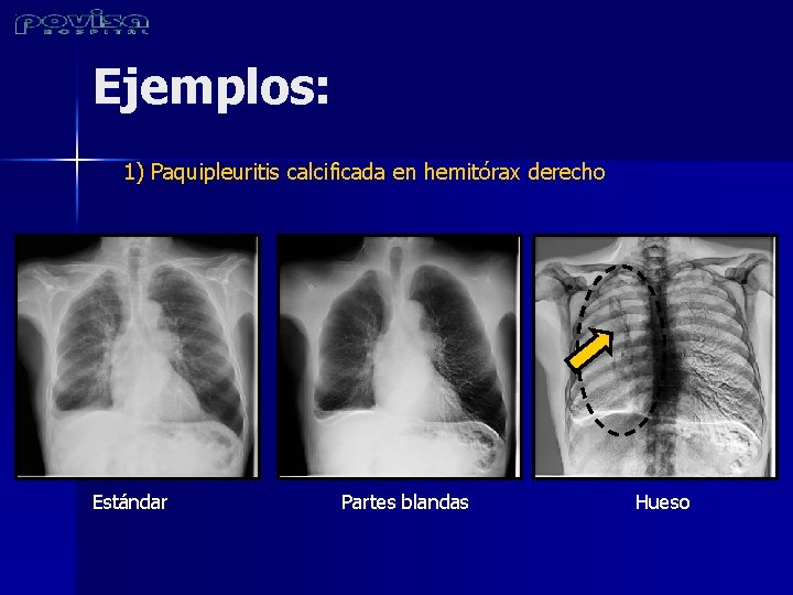 Ejemplos: 1) Paquipleuritis calcificada en hemitórax derecho Estándar Partes blandas Hueso 