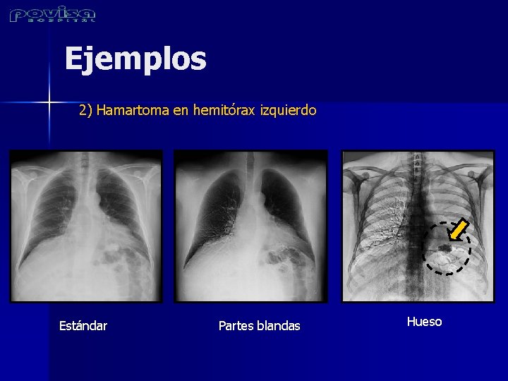 Ejemplos 2) Hamartoma en hemitórax izquierdo Estándar Partes blandas Hueso 