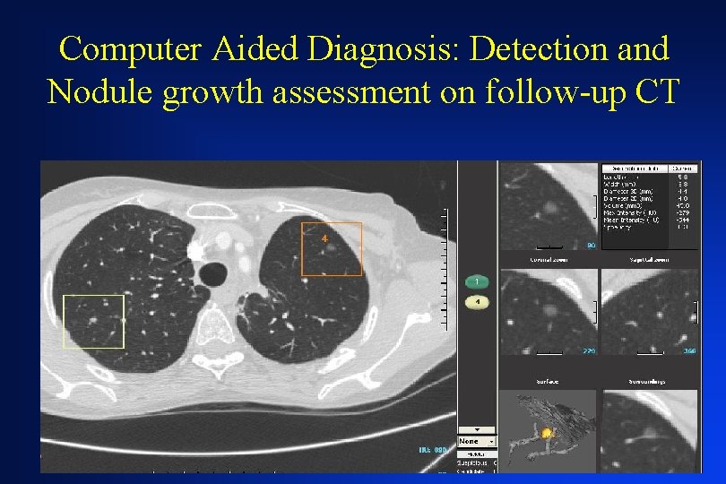 Computer Aided Diagnosis: Detection and Nodule growth assessment on follow-up CT 