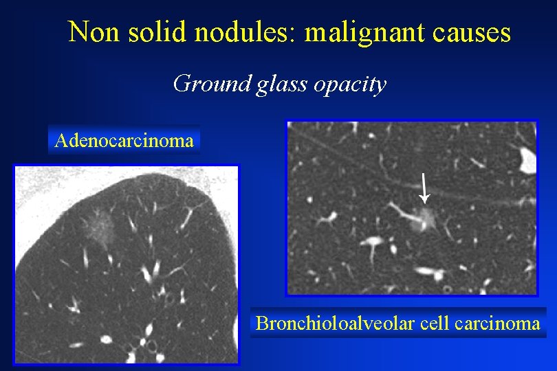 Non solid nodules: malignant causes Ground glass opacity Adenocarcinoma Bronchioloalveolar cell carcinoma 