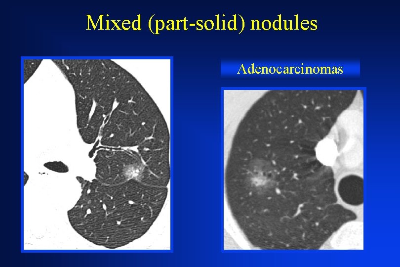 Mixed (part-solid) nodules Adenocarcinomas 