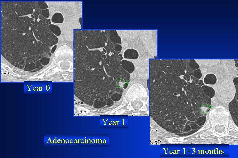 Year 0 Year 1 Adenocarcinoma Year 1+3 months 