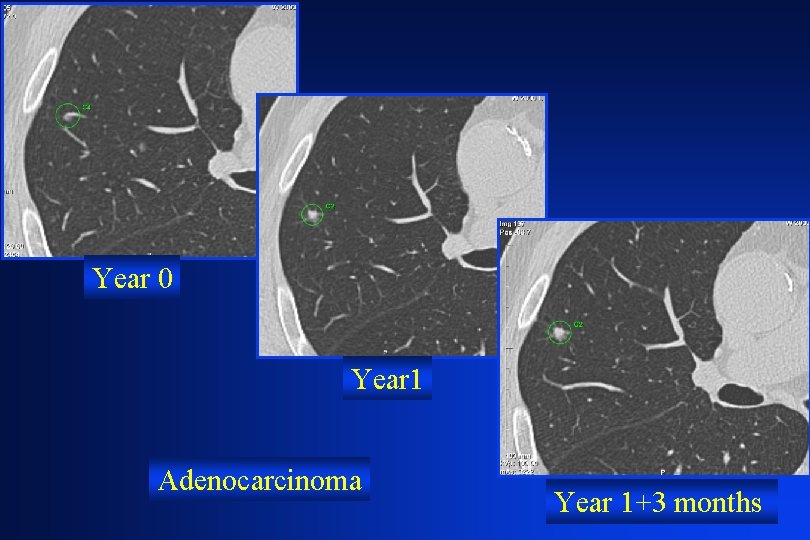 Year 0 Year 1 Adenocarcinoma Year 1+3 months 