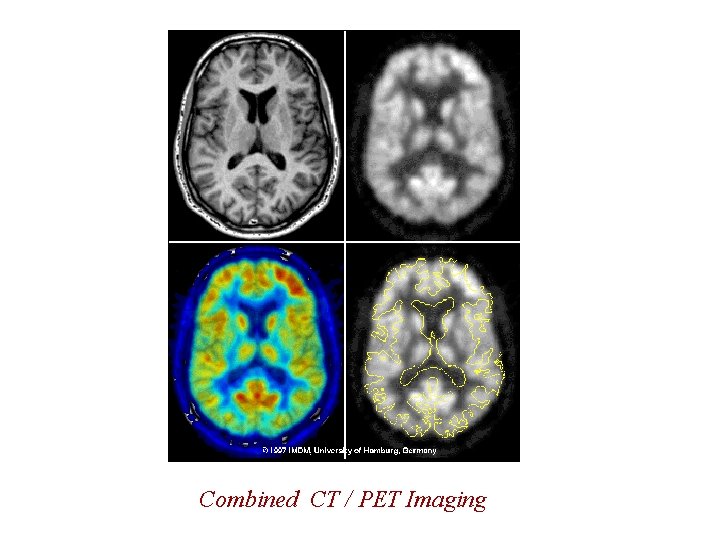Combined CT / PET Imaging Combined CT / PET Imaging