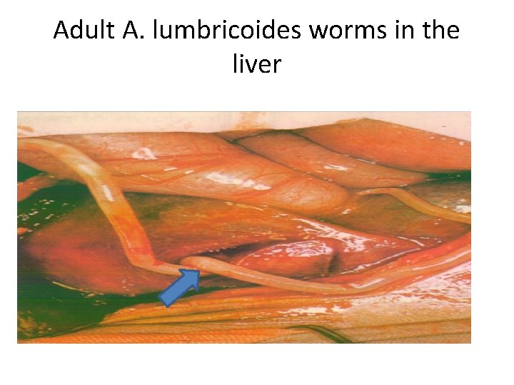 Adult A. lumbricoides worms in the liver 