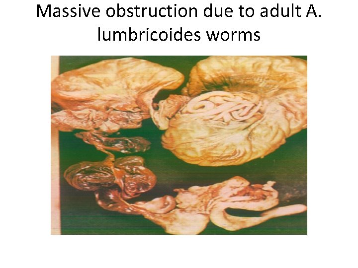 Massive obstruction due to adult A. lumbricoides worms 