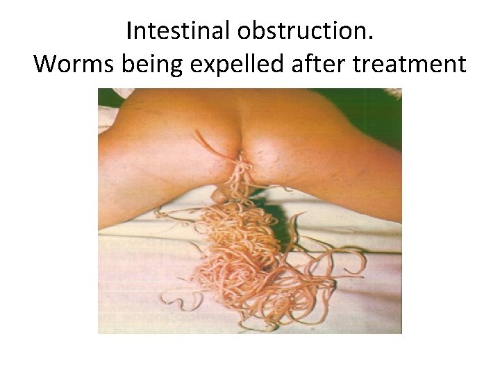 Intestinal obstruction. Worms being expelled after treatment 