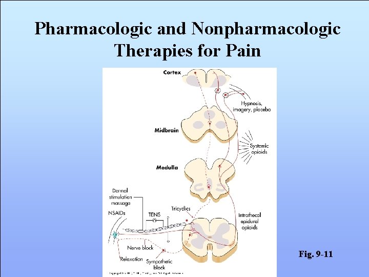 Pharmacologic and Nonpharmacologic Therapies for Pain Fig. 9 -11 