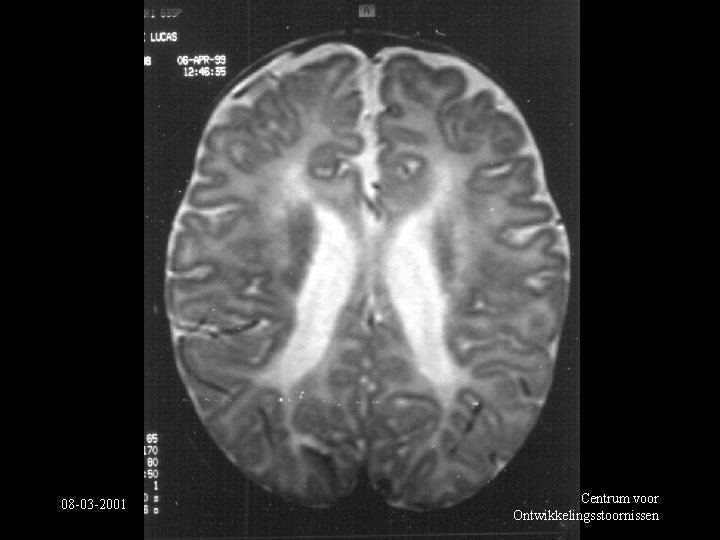 08 -03 -2001 Centrum voor Ontwikkelingsstoornissen 