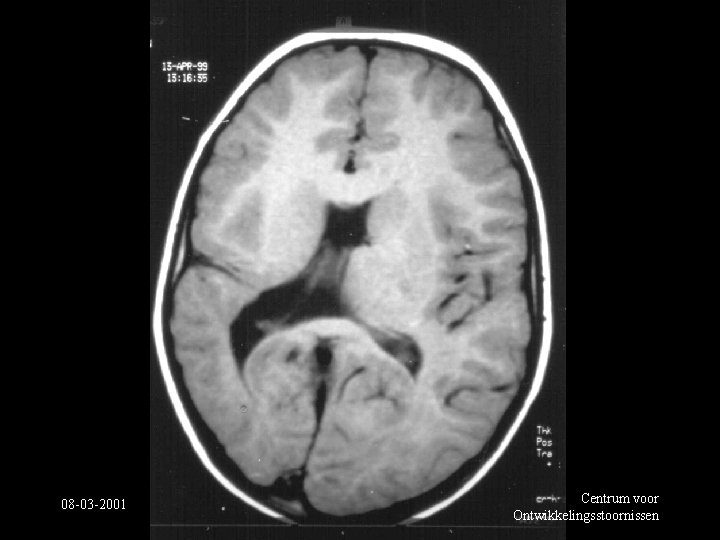 08 -03 -2001 Centrum voor Ontwikkelingsstoornissen 