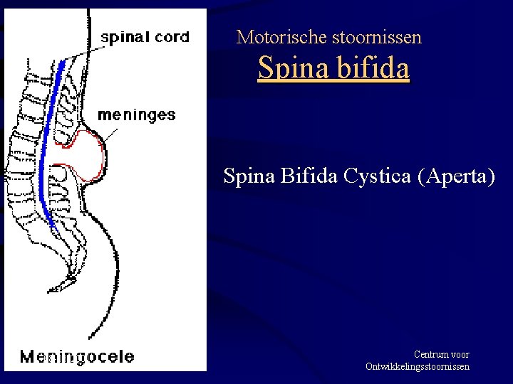 Motorische stoornissen Spina bifida Spina Bifida Cystica (Aperta) 08 -03 -2001 Centrum voor Ontwikkelingsstoornissen