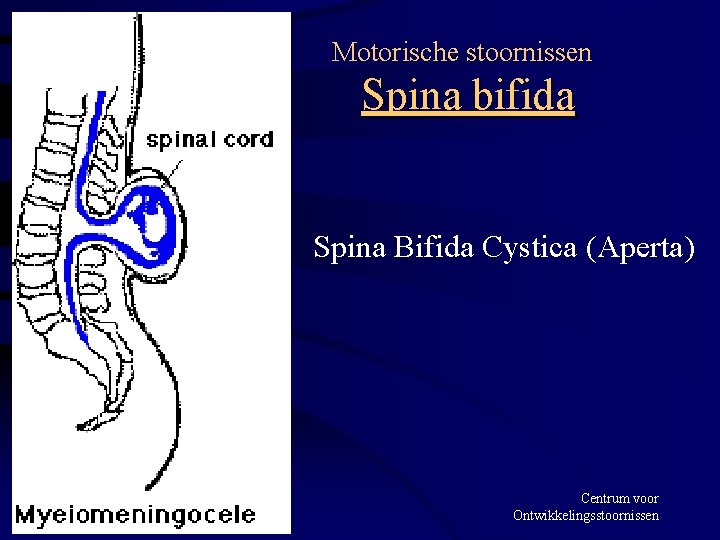 Motorische stoornissen Spina bifida Spina Bifida Cystica (Aperta) 08 -03 -2001 Centrum voor Ontwikkelingsstoornissen