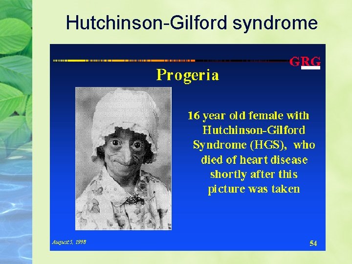 Hutchinson-Gilford syndrome 