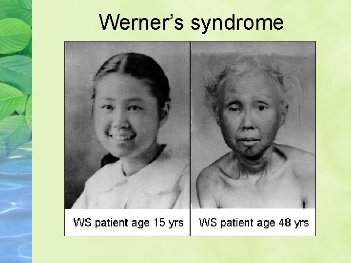 Werner’s syndrome 