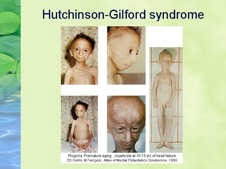 Hutchinson-Gilford syndrome 