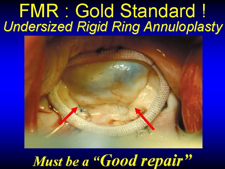 FMR : Gold Standard ! Undersized Rigid Ring Annuloplasty Must be a “Good repair”
