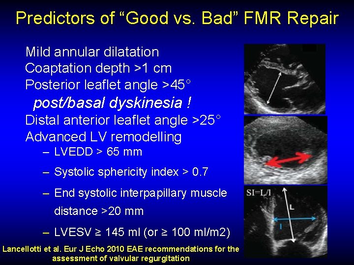 Predictors of “Good vs. Bad” FMR Repair Mild annular dilatation Coaptation depth >1 cm