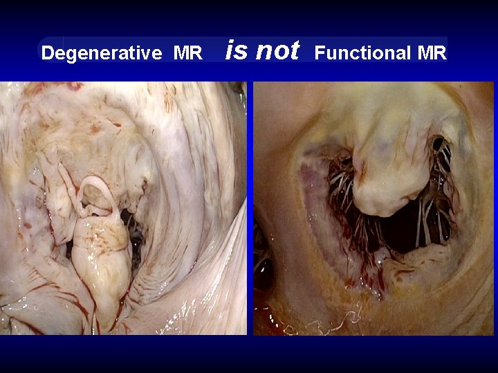 Degenerative MR is not Functional MR 