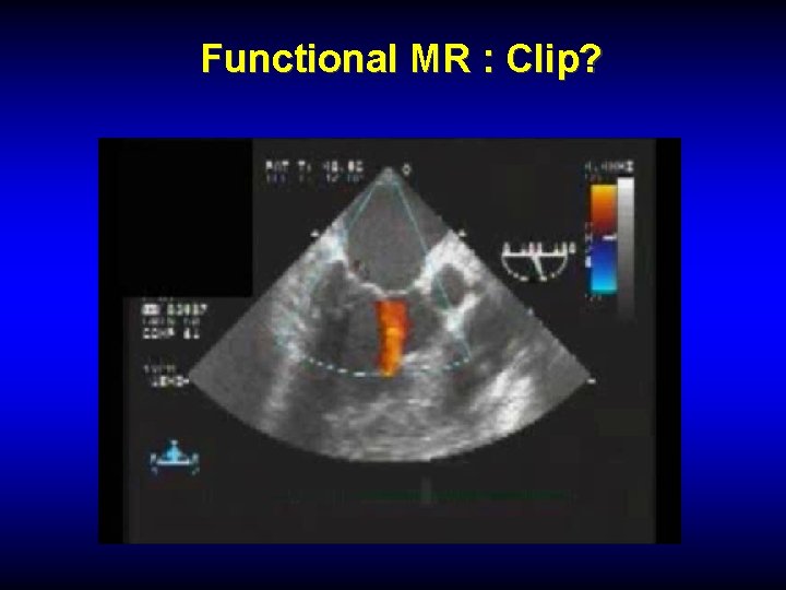 Functional MR : Clip? 