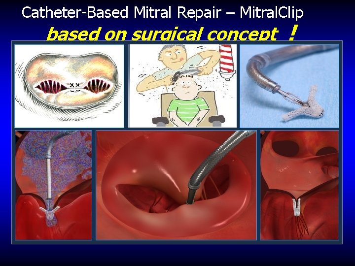 Catheter-Based Mitral Repair – Mitral. Clip based on surgical concept ! 