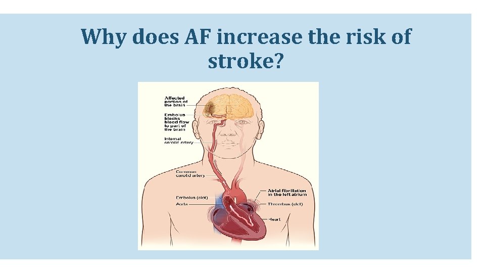 Why does AF increase the risk of stroke? Why does AF increase the risk of stroke?