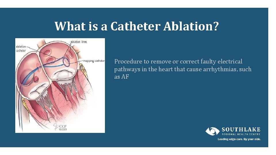 What is a Catheter Ablation? Procedure to remove or correct faulty electrical pathways in What is a Catheter Ablation? Procedure to remove or correct faulty electrical pathways in
