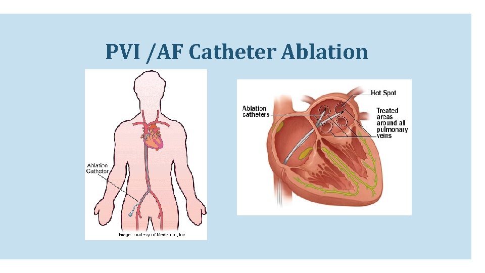 PVI /AF Catheter Ablation PVI /AF Catheter Ablation