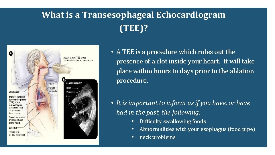 What is a Transesophageal Echocardiogram (TEE)? • A TEE is a procedure which rules What is a Transesophageal Echocardiogram (TEE)? • A TEE is a procedure which rules
