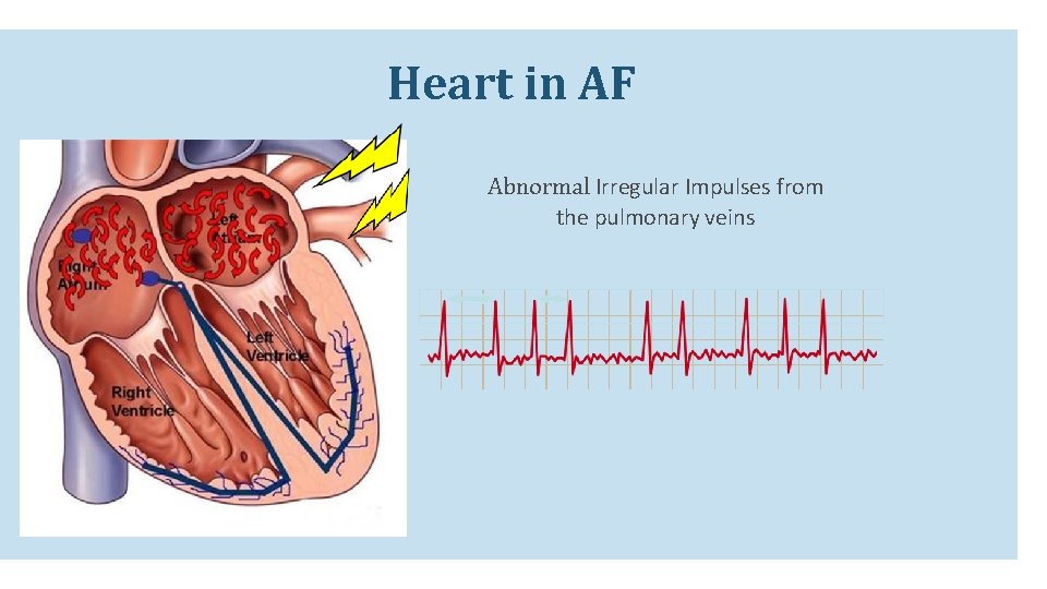 Heart in AF Abnormal Irregular Impulses from the pulmonary veins Heart in AF Abnormal Irregular Impulses from the pulmonary veins
